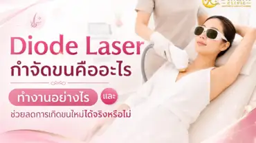 Diode Laser กำจัดขนคืออะไร ทำงานอย่างไร และช่วยลดการเกิดขนใหม่ได้จริงหรือไม่