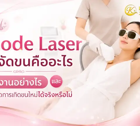 Diode Laser กำจัดขนคืออะไร ทำงานอย่างไร และช่วยลดการเกิดขนใหม่ได้จริงหรือไม่