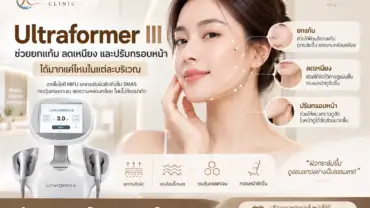 Ultraformer III ช่วยยกแก้ม ลดเหนียง และปรับกรอบหน้าได้มากแค่ไหนในแต่ละบริเวณ